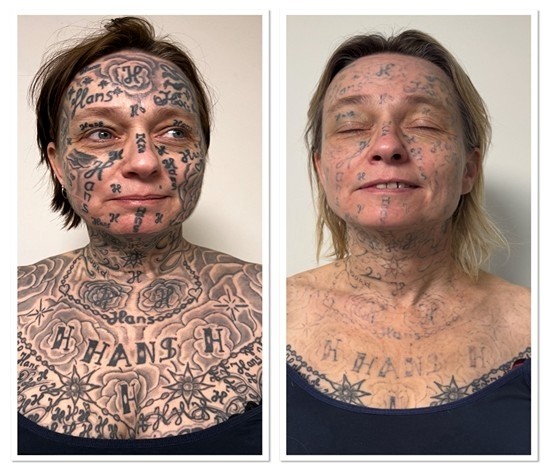 Spijt van Tattoo start actie om gedwongen tatoeages bij vrouwen te verwijderen